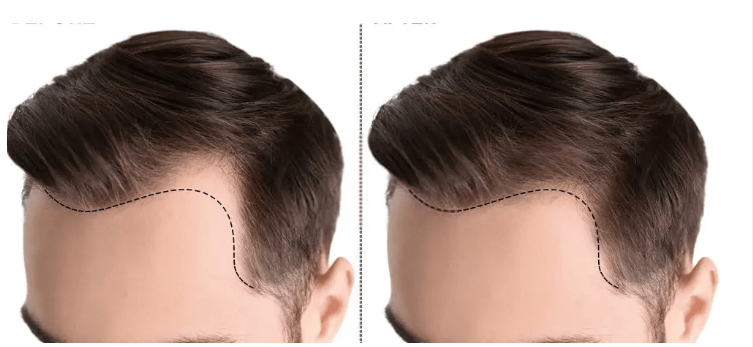 كیف تستعد لعملیة زراعة الشعر: نصائح قبل العملیة