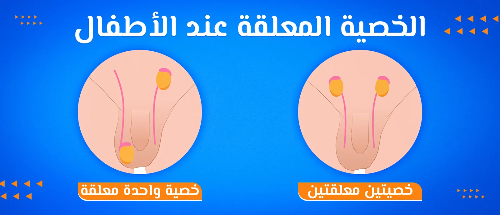 عملية الخصية المعلقة للأطفال: متى تُجرى؟ وكيف يتم العلاج وما التكلفة؟